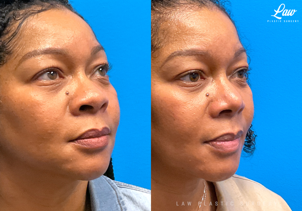 African American Rhinoplasty Before And After Photos Sage Plastic Surgery 7442